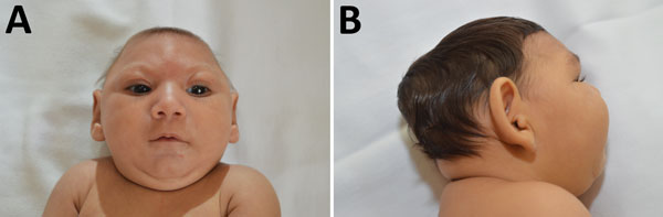 Characteristic phenotype of fetal brain disruption sequence in infants with probable congenital Zika virus syndrome, Sao Luís, Brazil, 2015–2016. A) Craniofacial disproportion and biparietal depression. B) Prominent occiput.