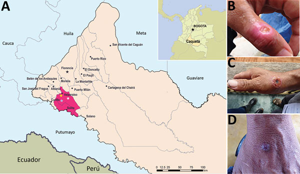 Location of 6 patients with poxvirus infections and photographs of lesions from 3 patients, Colombia, 2014. A) The municipalities of Valparaíso (residence of patients 1–5) and Solita (residence of patient 6) are 36 km apart in the southwestern region of the department of Caquetá. Yellow, white, and blue stars denote locations of patients 2, 3, and 4, respectively. Inset shows location of Caquetá in Colombia. Map source: Departamento Administrativo Nacional de Estadística (http://geoportal.dane.g
