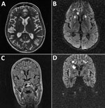 Thumbnail of Magnetic resonance imaging of the brain of a 28-year-old woman (patient 1) who had neurologic complications of influenza B virus infection, Romania. A) Axial T2 image showing multiple areas of T2-associated hyperintense lesions with involvement of the genu corpus callosum, bilateral internal capsule, and several areas of white matter in the right frontal lobe, and more discreetly at the limit between the right parietal and occipital lobe. B) Axial diffusion-weighted image showing re