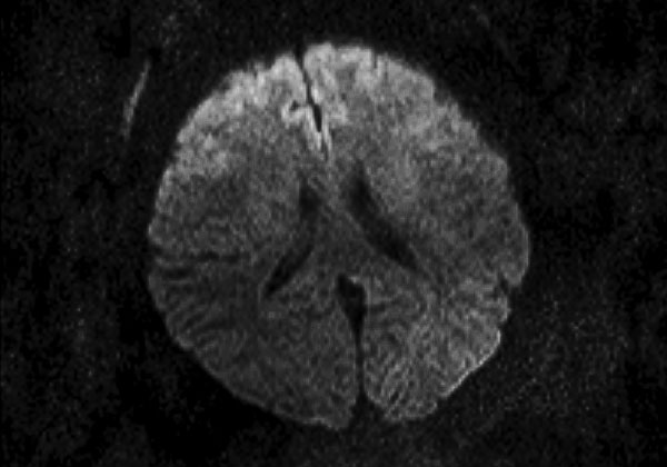 Magnetic resonance imaging of the brain of a 55-year-old woman (patient 3) who had neurologic complications of influenza B virus infection, Romania. Axial diffusion-weighted image showing restricted diffusion in the bilateral frontal cortex.