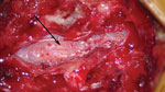 Thumbnail of Intraoperative image demonstrating postevacuation cauda equina nerve roots that are grossly edematous and adherent (arrow), consistent with arachnoiditis, in a patient with recurrent infection from fungal-contaminated methylprednisolone, North Carolina, USA, 2015.