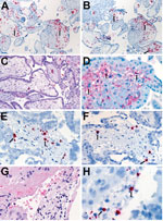 Thumbnail of Localization of Zika virus RNA by ISH in placental tissues of women after spontaneous abortion. A) ISH with use of antisense probe. Zika virus genomic RNA localization in placental chorionic villi, predominantly within Hofbauer cells (red stain, arrows), of a case-patient who had spontaneous abortion at 11 wk gestation (case-patient no. 56). Original magnification ×10). B) ISH with use of sense probe. Serial section showing negative–strand replicative RNA intermediates (red stain, a