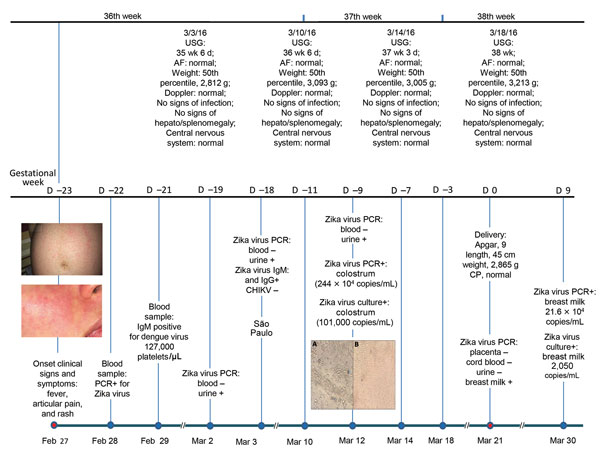 Timeline and clinical findings for a 28-year-old woman in the 36th week of pregnancy who had persistence of Zika virus in breast milk after infection in late stage of pregnancy and for her newborn, Manaus, Brazil. Top: ultrasound result for mother, fetus, and newborn. Bottom: follow-up test results for mother, fetus, and newborn. The 2 panels on the left show abdominal (top) and facial (bottom) rashes on the mother at the time of illness onset. Middle panels: Vero cell culture of breast milk and