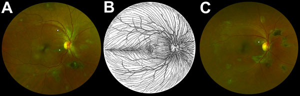 Composite scanning laser ophthalmoscope retinal images showing type 6 Ebola peripapillary or peripheral lesions, observed following the anatomic distribution of the ganglion cell axon (retinal nerve fiber layer), in a case–control study of ocular signs in Ebola virus disease survivors, Sierra Leone, 2016. A) Example 1, right eye. B) Illustration of the ganglion cell axon anatomic distribution. Courtesy of W.L.M. Alward. C) Example 2, right eye. Asterisks indicate curvilinear lesions distinct fro