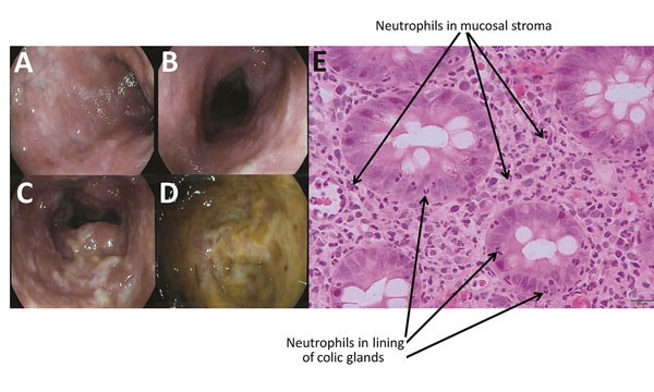 Endoscopic imagery of the distal sigmoid colon (A), proximal sigmoid colon (B), descending colon (C), and base of cecum (D), revealing diffuse colitis with mucosal erythema, edema, and mucopurulent exudate without ulceration. Colonic biopsy (E) demonstrating  neutrophilic infiltrates (indicated with arrows) in the epithelial lining of the colic glands and the mucosal stroma compatible with mild active colitis without signs of chronicity.