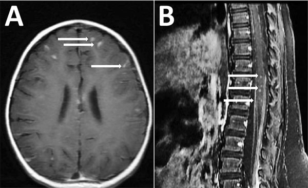 Magnetic resonance imaging (MRI) of the brain (A) and the spine (B) showing meningitis and myelitis in a 12-month-old girl with Angiostrongylus cantonensis infection, Houston, Texas, USA. A) Axial T1 post contrast sequences showing diffuse leptomeningeal enhancement (arrows). B) Sagittal T1 postcontrast sequences showing intramedullary enhancement in the thoracic and lumbar spinal cord T8–L5 with diffuse leptomeningeal enhancement (arrows).