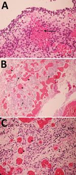 Thumbnail of Pathology findings for case 1, involving a fetus examined after pregnancy termination who had severe neurologic defects attributed to maternal Zika virus infection, Colombia. A) Remnant tissue of cerebral cortex showing a reduced neuroblast layer (dotted lines) and hemorrhagic foci (arrow). Hematoxylin and eosin (H&amp;E) staining; original magnification ×40. B) Glial leptomeningeal heterotopy showing congestive blood vessels (arrowhead) and foci of glial heterotopia (arrows). H&amp