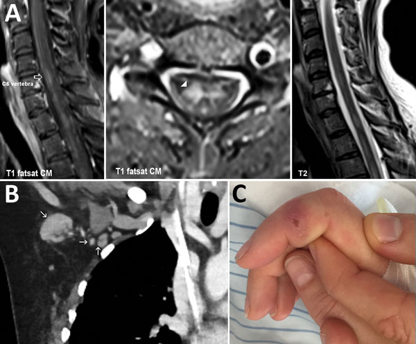 Images of woman with transverse myelitis and Bartonella henselea infection. A) Magnetic resonance image of the spine showing transverse myelitis. Fat-saturated (fs) T1-weighted image with contrast medium (cm), sagittal plane (left panel) and axial plane (middle panel). T2-weighted image, sagittal plane (right panel). B) Coronal view of computed tomography image of the chest, showing right axillar lymphadenopathy (arrows). C) Right index finger, showing a persistent ulcer from a cat scratch.