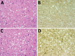 Thumbnail of Results of neuropathologic examinations of the brains of the 2 patients with sporadic Creutzfeldt-Jakob disease, United Kingdom, 2014. A) Microvacuolar spongiform change in the frontal cortex (case 1). Hematoxylin and eosin stain; original magnification ×400. B) Fine granular/synaptic accumulation of abnormal prion protein in the cerebral cortex (case 1). 12F10 antiprion protein antibody; original magnification ×400. C) Microvacuolar spongiform change with neuronal loss and gliosis 