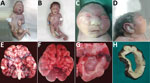 Thumbnail of Physical signs in 4 of 7 neonates who died of congenital Zika virus infection, Brazil. A) Neonate 1: typical microcephaly phenotype; arthrogryposis in upper and lower limbs. B) Neonate 7: microcephaly without the typical microcephaly phenotype; arthrogryposis is also present. C) Neonate 3: typical microcephaly phenotype, with head circumference within reference limits, frontal view. D) Neonate 3: typical microcephaly phenotype, with head circumference within reference limits, profil