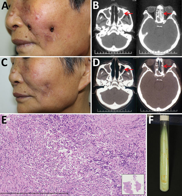 Mycobacterium gordonae infection in a 60-year-old immunocompetent woman, China. A) Facial lesions before treatment. Ulcers were erythematous and covered with yellow crusts. B) Computed tomography images before treatment show heterogeneous hypersignal in the ethmoid and left maxillary sinus (arrows). C) Facial lesions after treatment. Atrophic scars are seen at sites of previous lesions. D) Computed tomography images after treatment show recovery of the ethmoid sinus and left maxillary sinus (arr