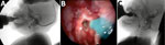 Thumbnail of Instrumental evaluation of an infant with dysphagia and microcephaly caused by congenital Zika virus infection, Brazil, 2015. A) Videofluoroscopic swallowing study image showing a lateral view of the infant with premature spillage of liquid food (with added contrast) in the pharynx before triggering of the swallowing reflex. B) Image of the fiberoptic endoscopic evaluation of a delay in initiation of swallowing; thickened, dyed liquid is visible on the supraglottis. C) Silent aspira