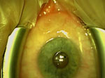 Thumbnail of Surgical extraction of a 13-cm worm from the eye of a patient with Dirofilaria repens infection.