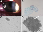 Thumbnail of Results of testing for a 17-year-old woman with keratoconjunctivitis symptoms, Marseille, France, July 2016. A) Slit-lamp optic microscopic photograph of left eye infected with pseudo-dendritic keratitis associated with Acanthamoeba castellani–“Attilina massiliensis” ocular infection. B) Microscopic aspect of A. castellani ameba infected by “A. massiliensis” from corneal swab sample. C) Optic microscopy image of flagellated, free-living “A. massiliensis” from swab sample. Scale bar 