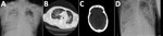 Thumbnail of Chest and brain imaging of 56-year-old man infected with highly pathogenic avian influenza A(H7N9) virus, China, 2017: radiograph imaging of chest at day 7 (A) and day 40 (D); computed tomographic scans of the chest (B) and the brain (C) at day 30.