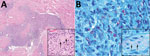 Thumbnail of Skin biopsies of 59-year-old white male US citizen showing Mycobacterium lepromatosis infection, 2017. A) Hematoxylin and eosin–stained section of a specimen from the chin showing granulomatous dermal inflammation (original magnification ×100); inset shows nerve involvement (arrows) that is diagnostic for leprosy (original magnification ×400). B) Fite-stained section of a specimen from the chin highlights numerous acid-fast bacilli within histiocytes (original magnification ×1,000);