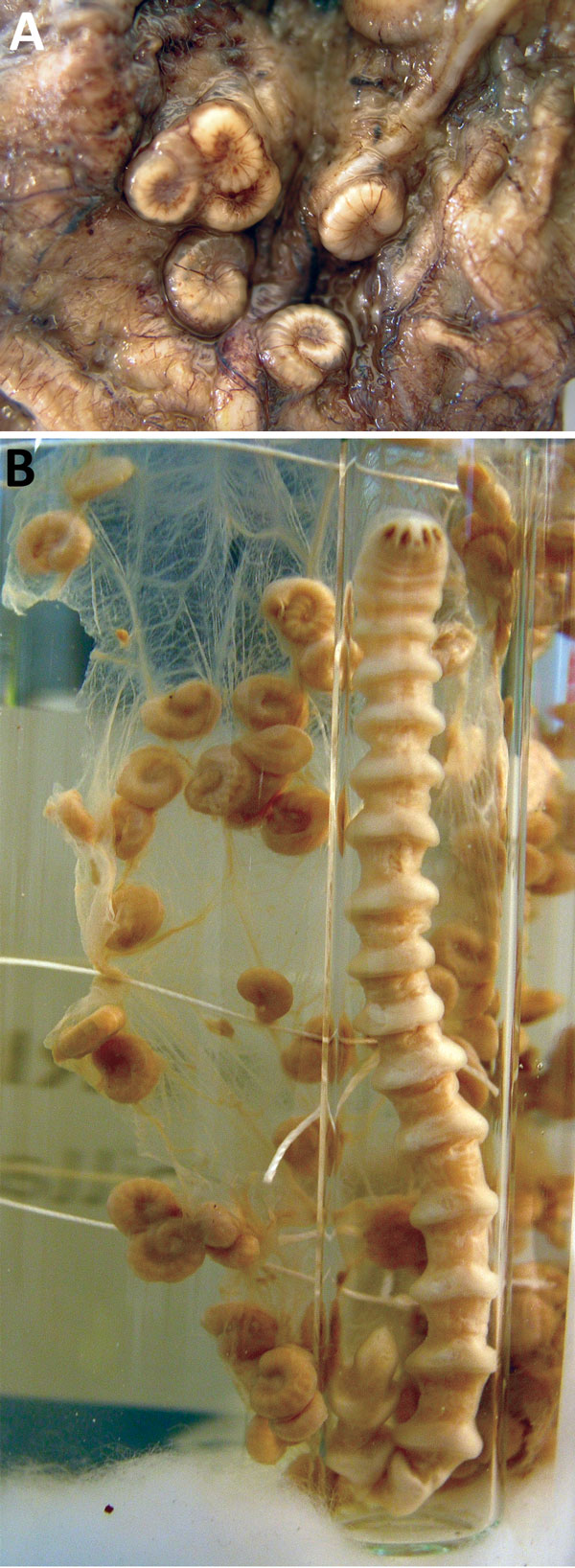 Armillifer armillatus parasites in man with pentastomiasis. A) Typically coiled Armillifer armillatus nymphs, averaging 1–2 cm long and consistently showing &lt;22 annuli. B) Adult female and numerous nymphs; reference material from the Educational Department, Institute of Tropical Medicine, Antwerp, Belgium. 