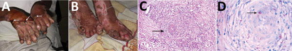 Diffuse multibacillary leprosy of Lucio and Latapí with Lucio’s phenomenon in a 65-year-old man in Peru. A) Vasculitis with necrosis of the superficial vascular plexus. Forearms and dorsum of hands show papulonodular dermotoses infiltrating erythematous lesions (white arrows). B) Patches of scaling skin or necrotic eschar on feet. C) Skin biopsy of leg (hematoxylin and eosin stain, original magnification ×40) showing largely unremarkable epidermis but collection of foamy histiocytes in dermis (b