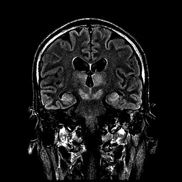 Magnetic resonance imaging of brain of index patient 66 days after double lung transplantation, Hong Kong, China. Coronal FLAIR (FLuid Attenuation Inversion Recovery sequence) image of the head at the level of the lateral ventricles, thalamus, and midbrain shows high signal at bilateral thalamus, midbrain, and medial temporal lobes.