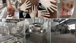 Thumbnail of Images from outbreak of vaccinia virus (VACV) from occupational exposure, China, March 2017. A) Lesion on thumb of case-patient 1; B, C) lesions on hands of case-patient 2; D) batch of frozen rabbit skin inoculated with VACV by a biopharmaceutical laboratory; E) live rabbit after VACV inoculation in the biopharmaceutical laboratory; F) machine used to pulverize rabbit skin; G) closed workspace where 5 case-patients pulverized rabbit skin. 