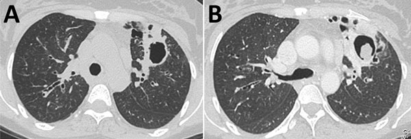 Computed tomography images of a patient with chronic pulmonary aspergillosis. A) Left upper lung lobe thick-walled cavity, showing associated pleural thickening. B) Same patient several months later, demonstrating progression of cavitation with increased pericavitary consolidation and formation of a fungal ball within the cavity. Aspergilloma formation is a late feature of chronic pulmonary aspergillosis.