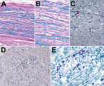 Thumbnail of Histopathologic evaluation of tissue specimens collected postmortem from a patient with Guillain-Barré syndrome (acute demyelinating inflammatory polyneuropathy variant) and Zika virus infection, Puerto Rico, 2016. A, B) Luxol fast blue-periodic acid-Schiff myelin stain of sciatic nerves show patchy myelin loss and variable inflammation. Original magnification x10(A) and x20(B). C) Detection of CD68 cells by immunohistochemistry (arrows) in sciatic nerve. Original magnification x20.