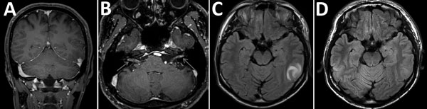Brain magnetic resonance imaging findings in a 36-year-old immunocompetent man before (A, B, C) and after (D) treatment for cerebral syphilitic gumma, Saitama, Japan. A) Gadolinium-enhancement T1-weighted coronal images show an enhanced nodular lesion in the left temporal lobe. B) Coronal gadolinium-enhanced T1-weighted images show enhancement within the cisternal segment of both the vestibulocochlear nerve complex and the facial nerve. C) Axial fluid-attenuated inversion recovery images show a 