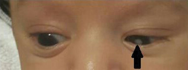 Left eye cataract (arrow) in case-patient with congenital rubella syndrome, Texas, USA, 2017. Patient was 4 weeks of age.
