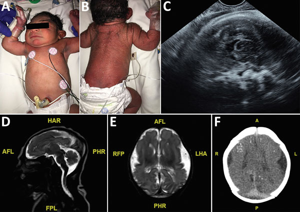 Term male infant (case-patient 1) with presumed congenital Zika syndrome, Brownsville, Texas, USA, 2016–2017. A) Microcephaly on the day of birth. Head circumference was 29 cm, which is 2.63 SDs below the mean value for term male newborns. Craniofacial abnormalities present are mild narrow and laterally depressed frontal bone and mild retrognathia. B) Generalized pustular melanosis rash. C) Prenatal transvaginal ultrasonographic (midsagittal plane) image at 37.2 weeks’ gestation, showing calcifi