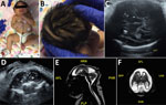 Thumbnail of Term female infant (case-patient 2) with presumed congenital Zika syndrome, Brownsville, Texas, USA, 2016–2017. A) Microcephaly on the day of birth. Head circumference was 26.5 cm, which is 6.23 SDs below the mean value for term females. Craniofacial disproportion with narrow and laterally depressed frontal bone are seen. Upper wrist contractures are present, more apparent on the right, with ulnar deviation. B) Redundant scalp skin with multiple rugae. C) Transabdominal ultrasonogra
