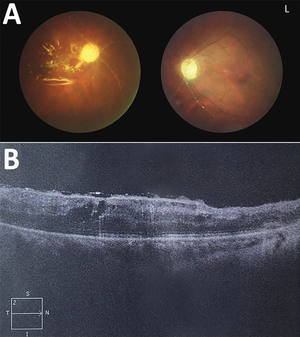 Ocular examination conducted 2 months after eye surgery in patient with human endophthalmitis caused by pseudorabies virus, China, 2017. A) Fundus photography of both eyes showing retinal necrosis and occlusive vasculitis and postoperative change after pars plana vitrectomy with silicone oil injection in the right eye. B) Optical coherence tomography of the patient’s right eye showed postoperative change after pars plana vitrectomy. 2, scan depth (2 mm); I, inferior, L, left eye; N, nasal side; 