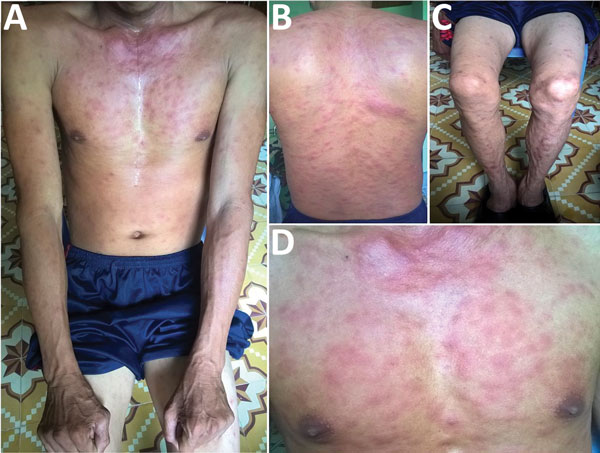 Rash on patient with dual genotype Orientia tsutsugamushi infection, Vietnam. A) Trunk and arms; B) back; C) legs; D) chest.