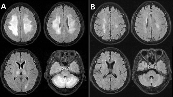 Thumbnail of Fluid-attenuated inversion recovery magnetic resonance images of the brain of a 55-year-old woman with dengue-associated posterior reversible encephalopathy syndrome, Ho Chi Minh City, Vietnam. A) Bilateral abnormal nonenhancing, confluent high signal in the periventricular and deep cerebral white matter of the high frontal parietal area and cerebellar hemispheres, thalamus, and pons. B) Almost complete resolution of abnormal findings 7 weeks later, after treatment.