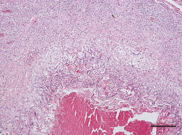 Coalescent granuloma in liver parenchyma of a pet green iguana (Iguana iguana) infected with Burkholderia pseudomallei, Belgium. Hematoxylin and eosin stain shows central necrosis surrounded by activated macrophages and giant cells. Scale bar indicates 200 μm.