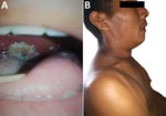 Thumbnail of Physical characteristics of 31-year-old Amerindian male index case-patient with diphtheria, Wonken, Venezuela, 2017. A) Firmly adherent gray-white pseudomembrane in pharynx. B) Typical bull-like neck swelling with massive cervical adenopathies.