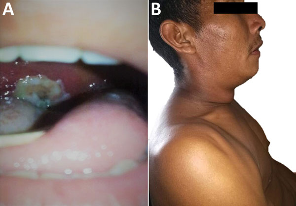 Physical characteristics of 31-year-old Amerindian male index case-patient with diphtheria, Wonken, Venezuela, 2017. A) Firmly adherent gray-white pseudomembrane in pharynx. B) Typical bull-like neck swelling with massive cervical adenopathies.