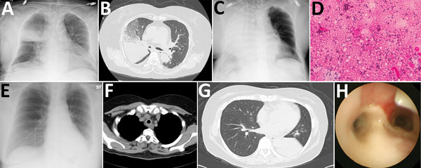 Radiological imaging, sputum smear finding, and endobronchial image of 2 case-patients with severe pneumonia caused by Corynebacterium ulcerans infection, Japan. Case-patient 1: A) Atelectasis in middle lung field at admission; B) consolidation and atelectasis in right upper lobe; C) rapid development of diffuse atelectasis; D) gram-positive rods in all fields of endotracheal aspiration sputum sample (original magnification x1,000). Case-patient 2: E) Infiltrates in left lower lung field; F) thi