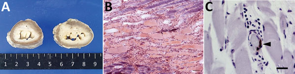 Lesions and epizootic hemorrhagic disease virus serotype 6 (EHDV-6) antigen in esophagus of necropsied cow, Japan, 2015. A) Dilatation of lumen. Cross-section of formalin-fixed esophagus of affected cow (right) and control (left). B) Hyaline degeneration of striated muscle accompanied by cell infiltration. Phosphotungstic acid–hematoxylin stain. Scale bar indicates 50 μm. C) EHDV-6 antigen (arrowhead) in vascular endothelium in esophageal muscularis externa. Immunohistochemical stain. Scale bar 