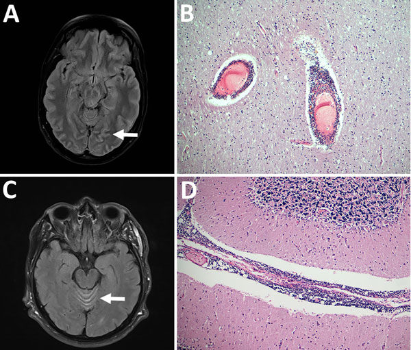 Pathologic and virologic findings for 2 patients with tick-borne encephalitis, Finland, 2015. A) Magnetic resonance images of 36-year-old woman (patient 1) with pathologically increased signal in cortical sulcus regions indicative of viral meningeal process (arrow). B) Hematoxylin and eosin staining of the frontal cortex of patient 1 showed inflammation throughout the central nervous system from the spinal cord to the cortex and cerebellum; original magnification ×100. C) Magnetic resonance imag