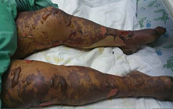 Case-patient 1, a 75-year-old woman with Israeli spotted fever and purpura fulminans, Sharon District, Israel, 7 days after hospitalization. A rash on the legs that had become bullous and contained clear serous fluid is shown.