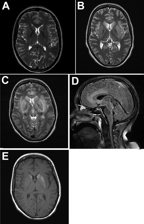 Magnetic resonance imaging of the brain throughout the course of the disease in patient who died of limbic encephalitis caused by variegated squirrel bornavirus 1 (VSBV-1), Germany, 2013. A) T2-weighted transversal image at admission showing no pathologic changes. B) T2-weighted image 3 weeks after admission showing edema in limbic structures (insula, hippocampus, anterior cingulate) and in the basal ganglia. C) T2-weighted image 4 weeks after admission showing progressive edema. Additional myel