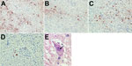 Thumbnail of Immunohistochemical and histologic slides of brain of patient who died of limbic encephalitis caused by variegated squirrel bornavirus 1 (VSBV-1), Germany, 2013. Immunohistochemistry of viral antigen in subcortical areas of the brain was performed by using a polyclonal antiserum against VSBV-1 N protein. Viral antigen was present in neurons and glial cells in nuclei and cytoplasm. A) Substantia nigra. Immunoperoxidase stain with hematoxylin counterstain; original magnification ×200.