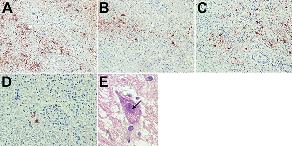 Immunohistochemical and histologic slides of brain of patient who died of limbic encephalitis caused by variegated squirrel bornavirus 1 (VSBV-1), Germany, 2013. Immunohistochemistry of viral antigen in subcortical areas of the brain was performed by using a polyclonal antiserum against VSBV-1 N protein. Viral antigen was present in neurons and glial cells in nuclei and cytoplasm. A) Substantia nigra. Immunoperoxidase stain with hematoxylin counterstain; original magnification ×200. B) Striatum.