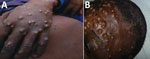 Thumbnail of Vesiculopustular rash on hand (A) and face (B) of patient with monkeypox.