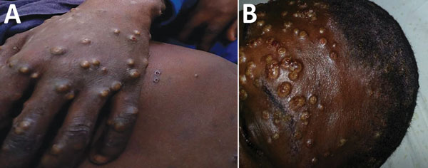 Vesiculopustular rash on hand (A) and face (B) of patient with monkeypox.