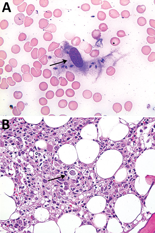 Bone marrow smear sample (A) and bone marrow aspirate (B) for patient 2 with visceral leishmaniasis caused by Leishmania infantum, Lebanon. Arrows show amastigotes within macrophages. Panel A, Wright Giemsa stain, original magnification x400; panel B, hematoxylin and eosin stain, original magnification x200.