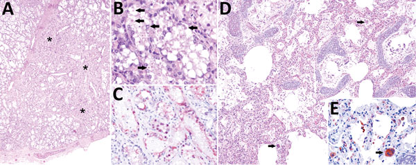 Cetacean morbillivirus–associated histopathologic findings in 2 Guiana dolphins (Sotalia guianensis), a female adult (case 1, panels A–C) and a male calf (case 2, panels D–E) A) The mammary gland parenchyma is focally disrupted by lymphohistiocytic inflammatory cells (not visible at this magnification) associated with collapsed and lost acini, and mild fibrosis (asterisks). Original magnification ×40; hematoxylin and eosin (H&amp;E) stain. B) Swollen and degenerating mammary acinar epithelial ce