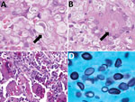 Thumbnail of Pathologic findings from patients infected with African histoplasmosis, Democratic Republic of the Congo, July 2011–January 2014. A) Yeast explosive budding (arrow) (hematoxylin and eosin [HE] staining; original magnification ×160); B) asteroid bodies (arrow) (HE staining; original magnification ×160); C) yeasts in Langhans cells (periodic acid Schiff staining; original magnification ×160); D) lemon-shaped appearance (Grocott methenamine-silver staining; original magnification ×80).