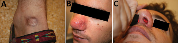 Cutaneous leishmaniasis and mucosal leishmaniasis in a traveler returning to Israel from Bolivia. A) Round hyperpigmented patch on the dorsum of right leg, representing old cutaneous leishmaniasis scar. B) Indurated erythematous patch of the nasal skin of the same patient appearing after 1 year. C) Illuminating in the right nostril sheds light into the left side, reflecting a hole within the nasal septum.