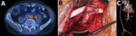 Thumbnail of Preoperative, intraoperative, and postoperative images in the case of a patient who received an abdominal aortic endograft and was later diagnosed with Mycobacterium chimaera and Granulicatella adiacens infection, Switzerland, 2014. A) 18Fluorodeoxyglucose positron emission tomography–computed tomography scan at diagnosis indicating a strong, metabolically active (maximum standard uptake value 9.7) aortic endograft infection and an adjacent abscess formation in the iliopsoas in clos